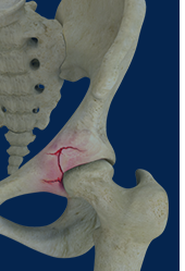 Hip and Pelvis Fracture Surgery