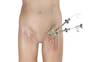 Hip arthroscopy