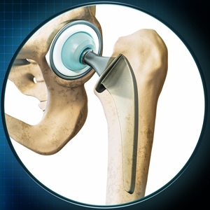 Best Hip Surgeon in Englewood: 7 Things You Must Know Before Choosing Your Doctor