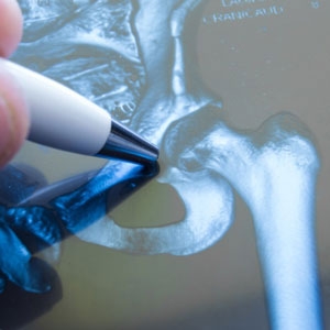 Hip Surgeon New York Explains: Are You a Candidate for Robotic Direct Anterior Hip Replace...