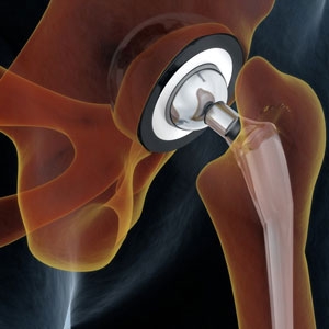 How AI and Robotics Are Transforming Hip Replacement Surgery in New York
