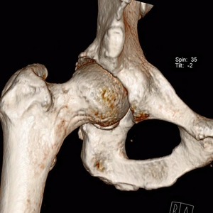 Robotic Direct Anterior Hip Replacement in New York: Is This the Most Advanced Hip Surgery...