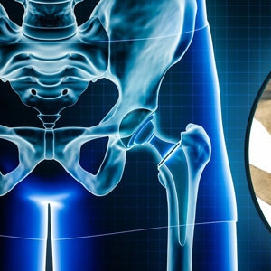 Robotic vs Traditional Hip Replacement in New York: Which Delivers Better Accuracy?