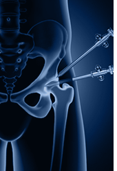 Hip Arthroscopy