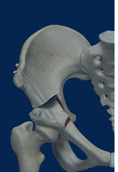 Pelvic Osteotomy